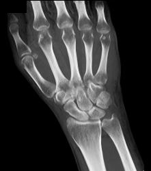 Fracture/dislocation in 3D - CTisus CT Scan