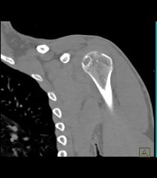 Cystic Changes Humerus With Effusion - CTisus CT Scan