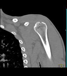 Cystic Changes Humerus With Effusion - CTisus CT Scan