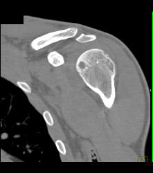 Cystic Changes Humerus With Effusion - CTisus CT Scan