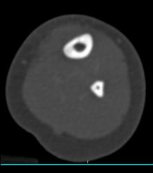 Subtle Tibial Fracture - CTisus CT Scan