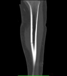 Subtle Tibial Fracture - CTisus CT Scan