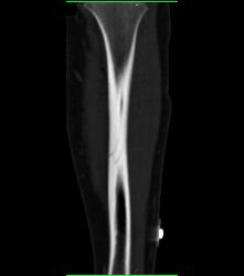 Subtle Tibial Fracture - CTisus CT Scan