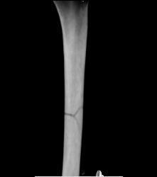 Nonunion Femur - CTisus CT Scan