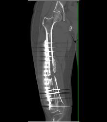 Nonunion Femur - CTisus CT Scan