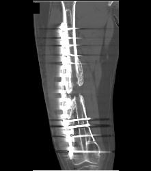 Nonunion Femur - CTisus CT Scan