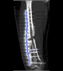 Nonunion Femur - CTisus CT Scan