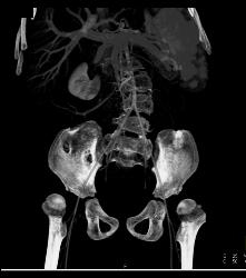 Dysplastic Hips - CTisus CT Scan