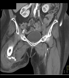 Ulcerations Thigh - CTisus CT Scan