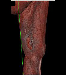 Ulcerations Thigh - CTisus CT Scan