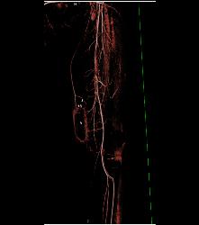 Ulcerations Thigh - CTisus CT Scan