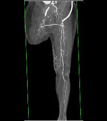 Ulcerations Thigh - CTisus CT Scan