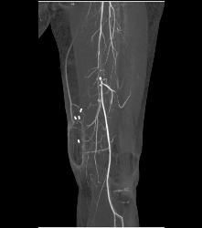 Ulcerations Thigh - CTisus CT Scan