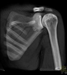 Scapular Fracture - CTisus CT Scan