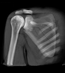 Scapular Fracture - CTisus CT Scan