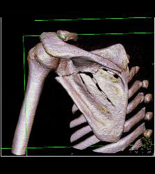 Scapular Fracture - CTisus CT Scan