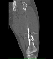 Femur Fracture S/p GSW - CTisus CT Scan