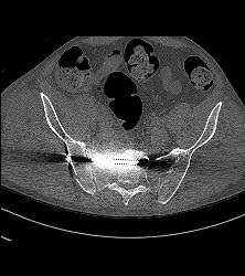 Hardware to Reduce Pelvis Fracture - CTisus CT Scan