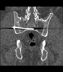 Hardware to Reduce Pelvis Fracture - CTisus CT Scan