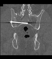 Hardware to Reduce Pelvis Fracture - CTisus CT Scan