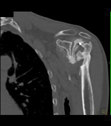 Osteonecrosis of Humeral Head - CTisus CT Scan