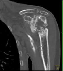 Osteonecrosis of Humeral Head - CTisus CT Scan