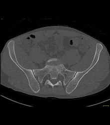 Subtle Cystic Lesion S-1 That Was Metastatic - CTisus CT Scan