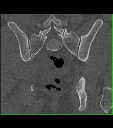 Subtle Cystic Lesion S-1 That Was Metastatic - CTisus CT Scan