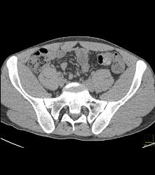 Subtle Cystic Lesion S-1 That Was Metastatic - CTisus CT Scan