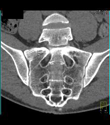 Subtle Cystic Lesion S-1 That Was Metastatic - CTisus CT Scan