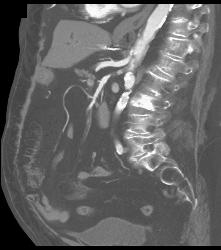 Subtle Cystic Lesion S-1 That Was Metastatic - CTisus CT Scan