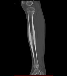 Osteoid Osteoma - CTisus CT Scan