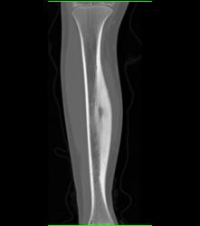 Osteoid Osteoma - CTisus CT Scan