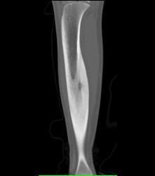 Osteoid Osteoma - CTisus CT Scan