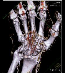 CTA of Hand With Vasculitis - CTisus CT Scan