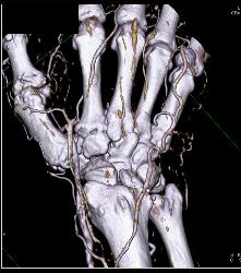 CTA of Hand With Vasculitis - CTisus CT Scan