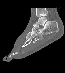 Nice Calcaneus With Mild Degenerative Joint Disease (DJD) With Foot Blister - CTisus CT Scan