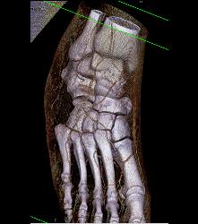 Nice Calcaneus With Mild Degenerative Joint Disease (DJD) With Foot Blister - CTisus CT Scan