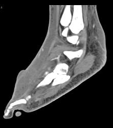 Nice Calcaneus With Mild Degenerative Joint Disease (DJD) With Foot Blister - CTisus CT Scan