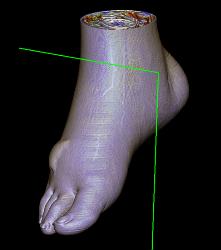 Nice Calcaneus With Mild Degenerative Joint Disease (DJD) With Foot Blister - CTisus CT Scan