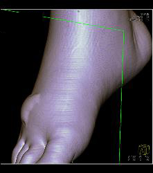 Nice Calcaneus With Mild Degenerative Joint Disease (DJD) With Foot Blister - CTisus CT Scan