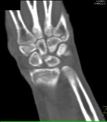 Scaphoid Fracture - CTisus CT Scan