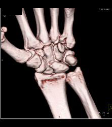 Scaphoid Fracture - CTisus CT Scan