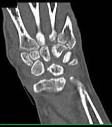 Scaphoid Fracture - CTisus CT Scan