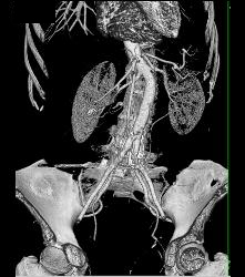 Hardware Extends and Is Adjacent to Aorta - CTisus CT Scan