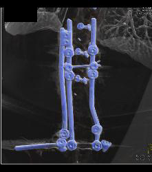 Hardware Extends and Is Adjacent to Aorta - CTisus CT Scan