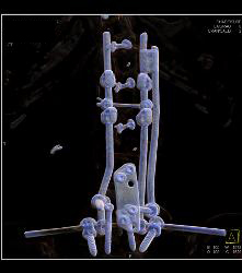 Hardware Extends and Is Adjacent to Aorta - CTisus CT Scan