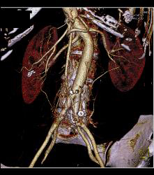 Hardware Extends and Is Adjacent to Aorta - CTisus CT Scan