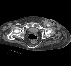 Psuedoaneurysm in Infected Groin - CTisus CT Scan