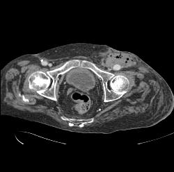 Hardware Extends and Adjacent to Aorta - CTisus CT Scan